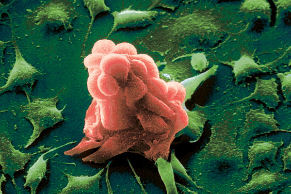 Английские ученые-биологи отыскали новый способ лечения рака
