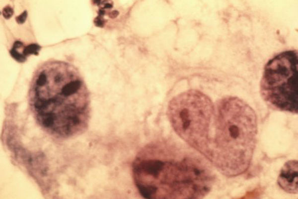 Тест-полоски на рак и малярию