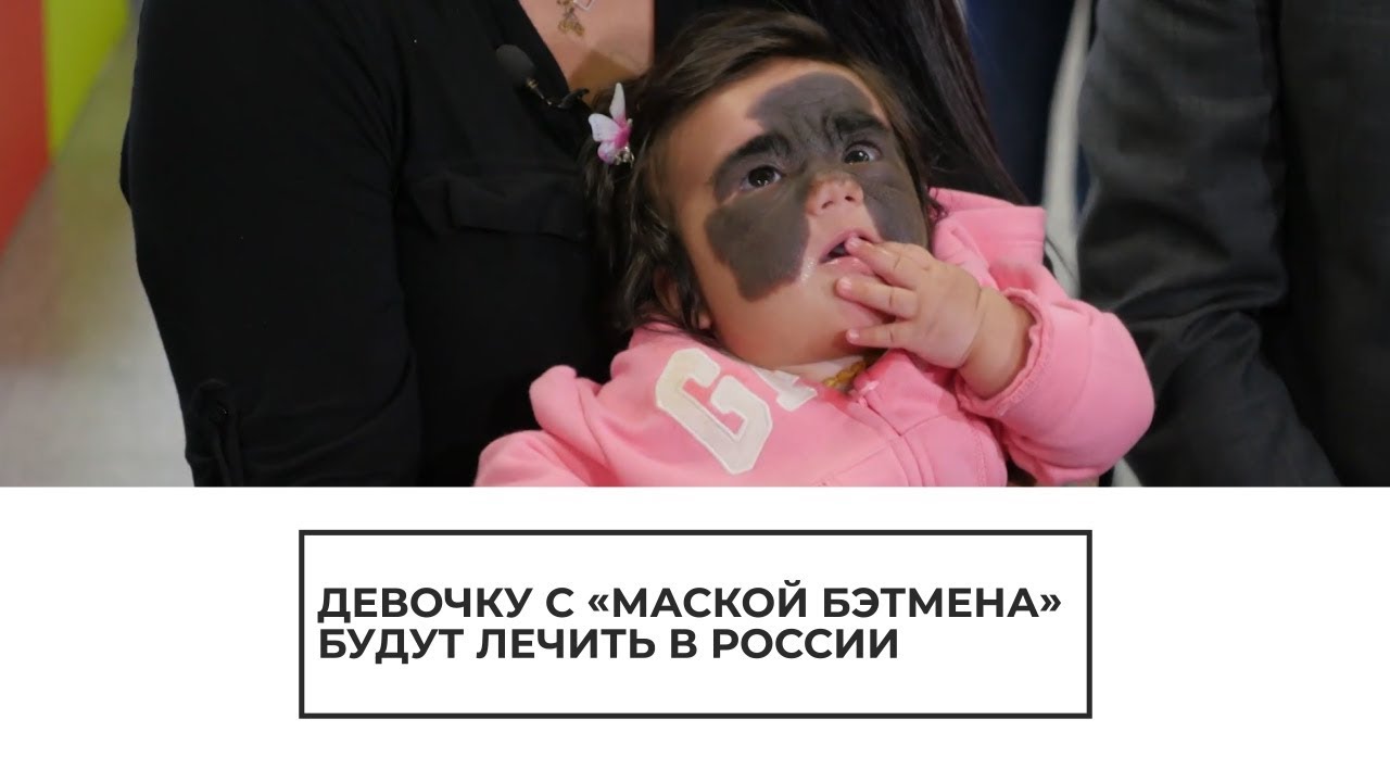 Девочку с "маской бэтмена" будут лечить в России
