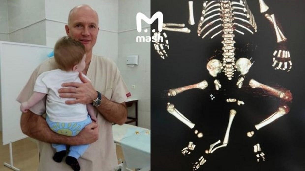 Столичные мед. персонал провели успешную операцию ребенку, родившемуся с тремя ногами
